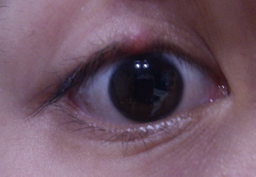 眼皮肿了有个小疙瘩怎么回事,针眼会引起眼皮肿吗