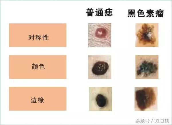 你有雀斑黄褐斑吗,脸黄长褐斑