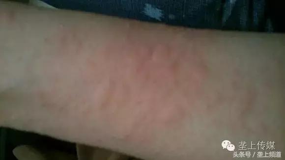 她年年吃螃蟹都没事，今年吃却满身长紫斑还尿血！为啥？