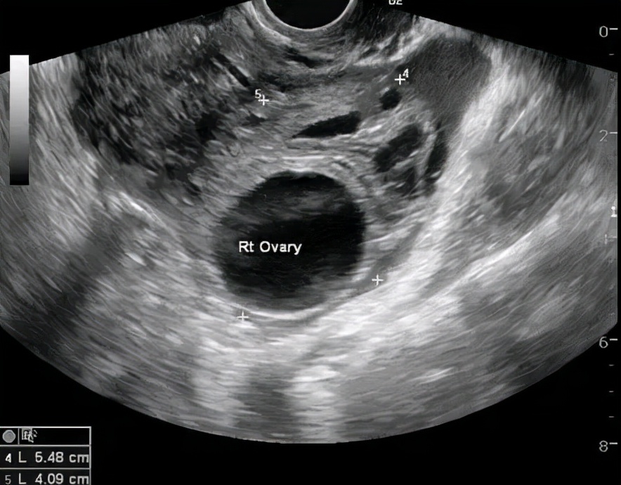 体检卵巢有个囊肿要紧不要紧,体检卵巢囊肿什么原因