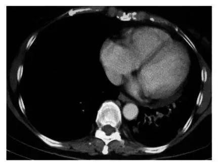 癌症疫苗将问世是真的吗,癌症疫苗或将问世