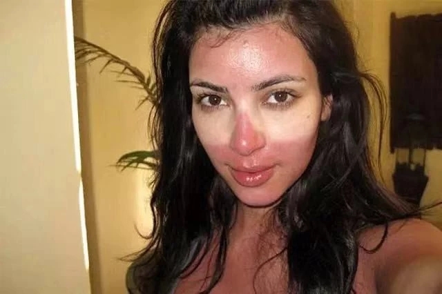 光过敏/多形性日光疹