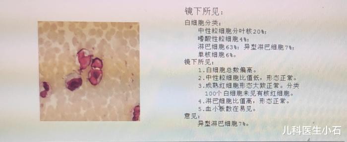 儿童eb病毒感染肝受损严重吗,EB病毒感染是什么