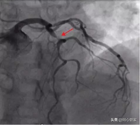 造影如何判断是血栓还是斑块,斑块和血栓ct区别