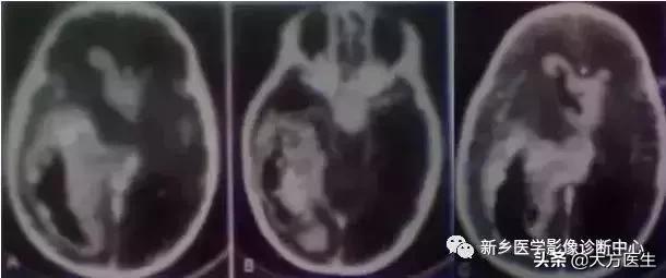 钙化灶是良性肿瘤的可能性大吗,颅内肿瘤钙化发生率最高