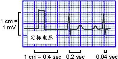 心律失常55分钟讲解,心律失常心电图讲解视频教程全集