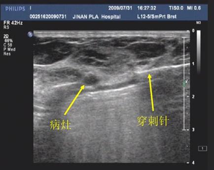 乳腺纤维腺瘤多少钱,复合型乳房纤维腺瘤