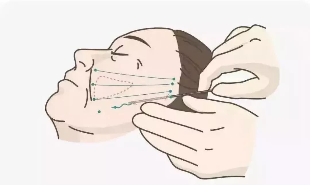 美颜都遮不住的法令纹该怎么回答,滤镜才是法令纹的天敌