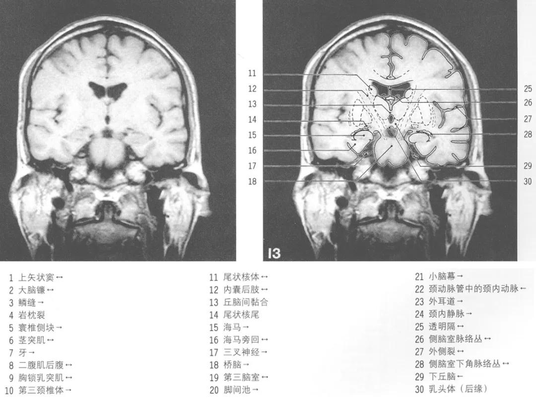 颅脑冠状状切面解剖图,颅脑mr解剖结构图