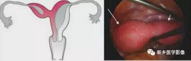 子宫发育异常，应想到的6大类常见畸形
