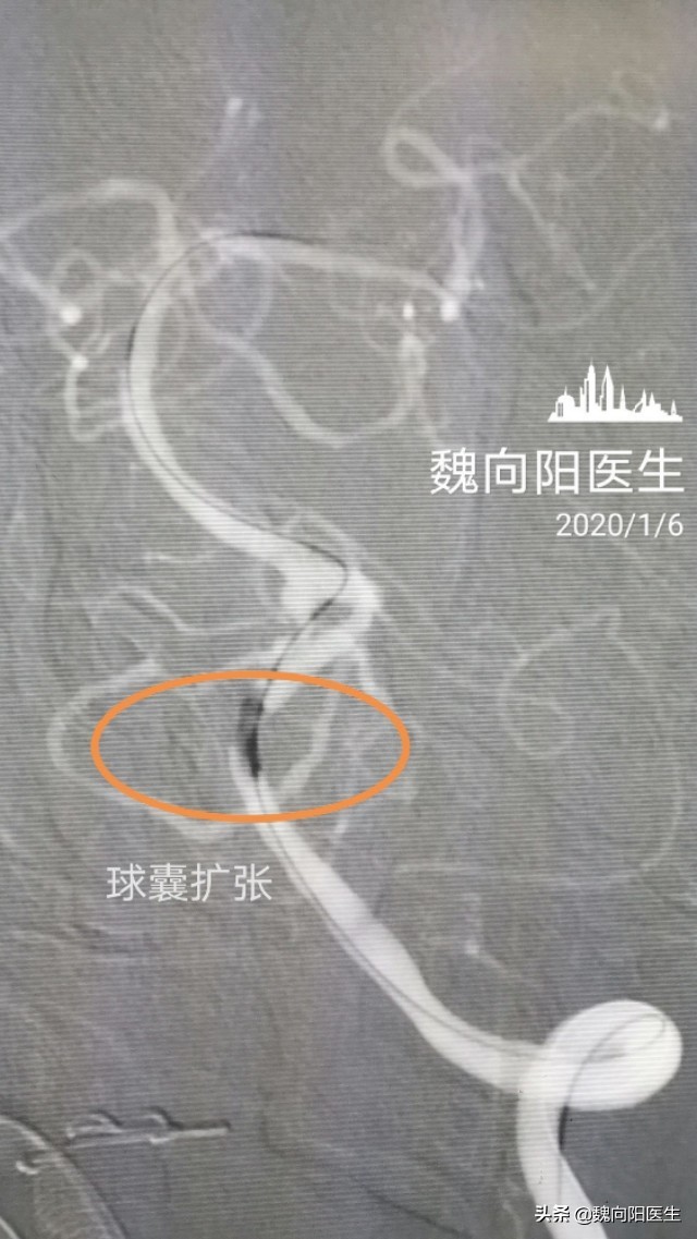 放入支架腰疼怎么办,支架后头晕怎么回事