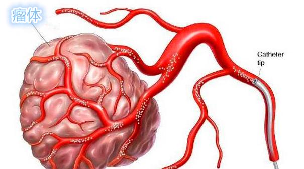 中晚期宫颈癌最佳方法,七十老人宫颈癌中晚期怎么治疗好