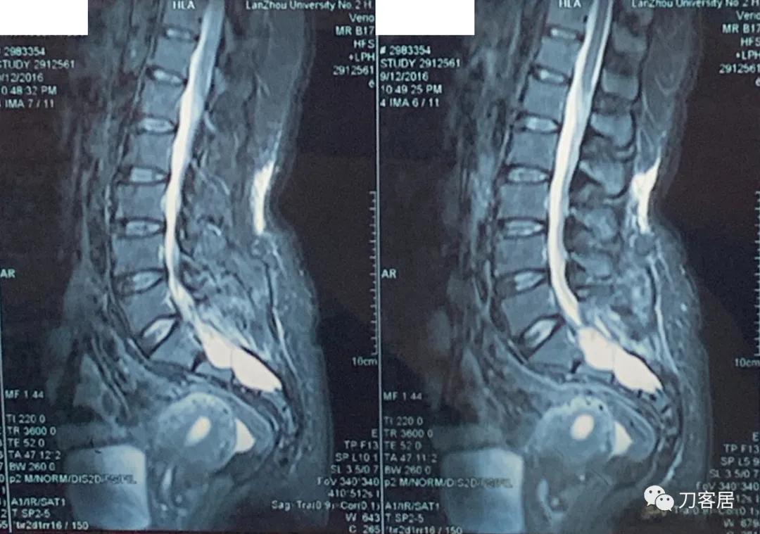髋关节骶管囊肿,骶管囊肿手术后右腿还是疼咋回事