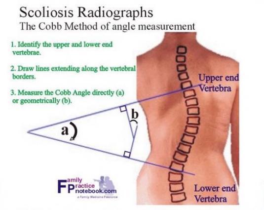 10岁孩子脊柱凸起是什么原因,10岁孩子后背脊柱突出图片