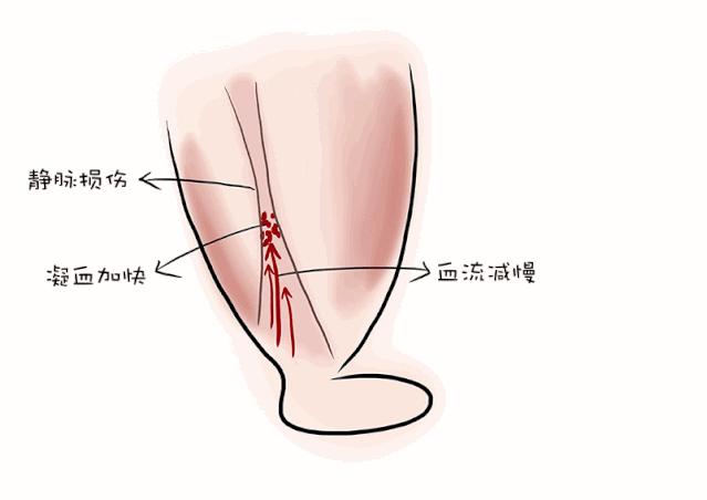 孕妈怎么做预防胎儿缺氧,孕妈如何预防主动脉夹层