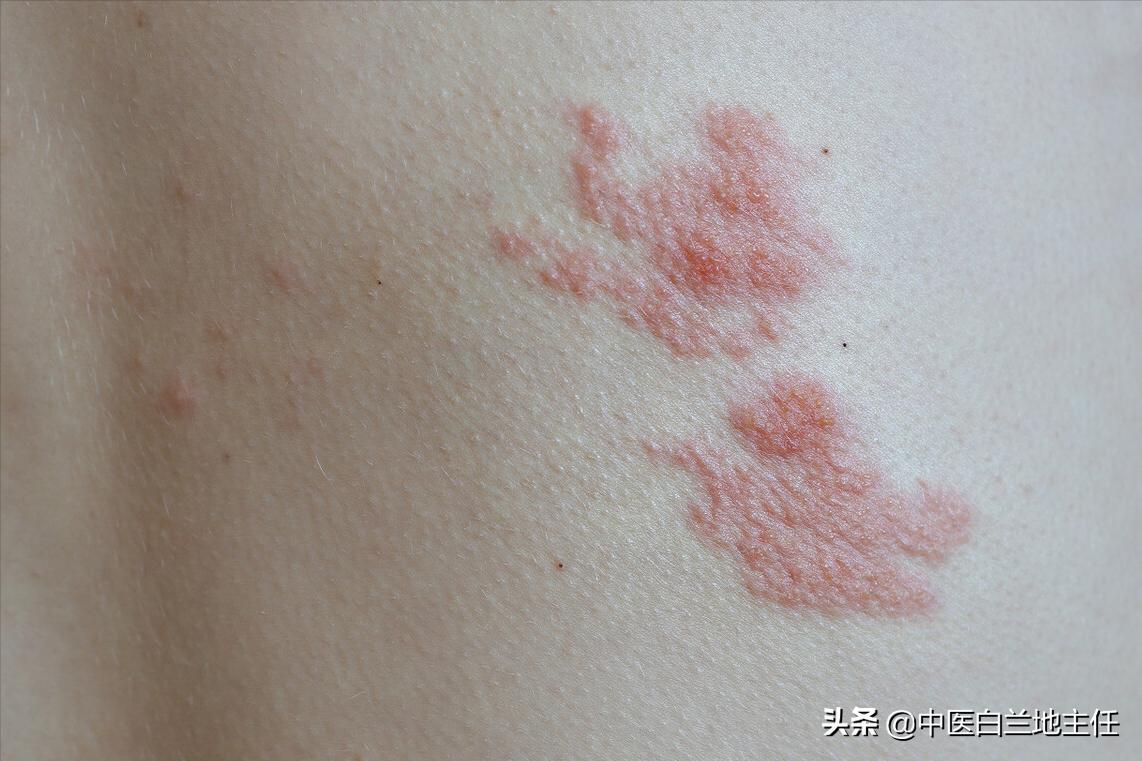 「病例分享」中医辨证施治7副Y解决带状疱疹
