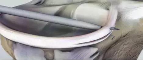 半月板手术强生缝合器,强生手术缝合线型号图