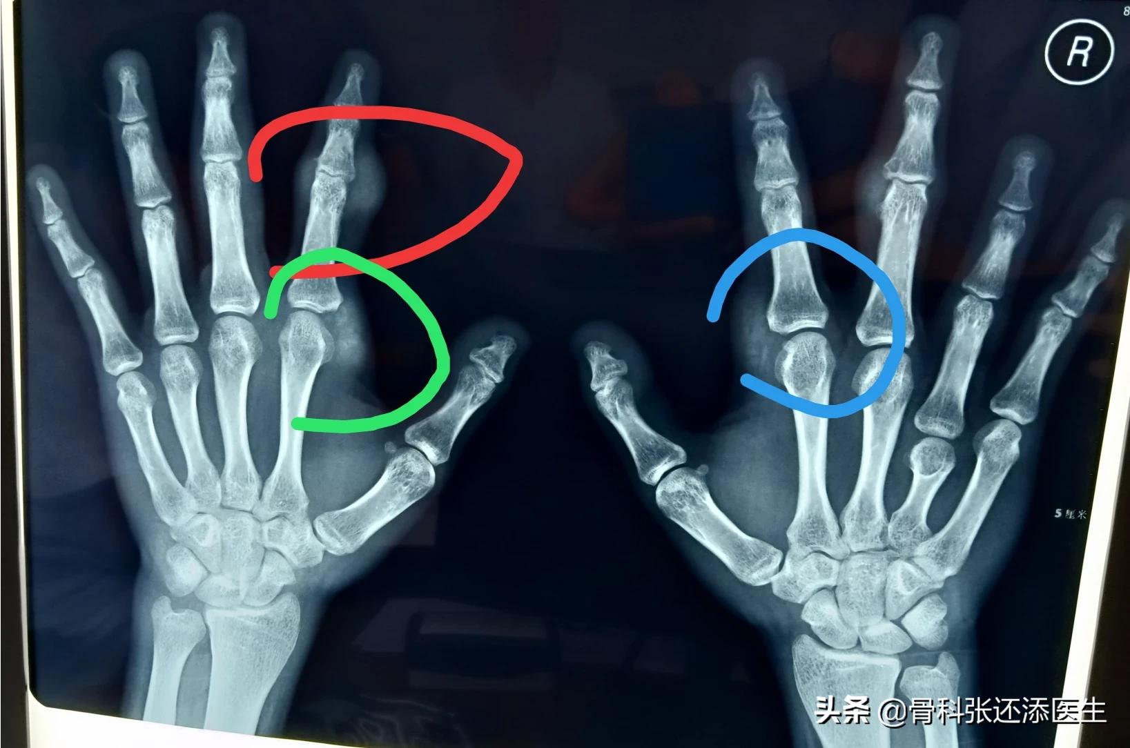 为什么医生不建议痛风石手术,医生为什么不建议痛风石手术