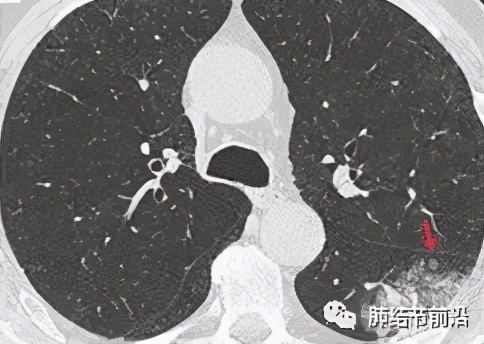 肺癌的肺泡间转移,STAS对肺结节临床处理的指导意义