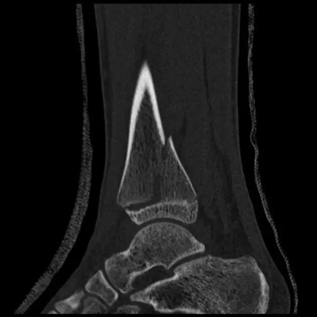 几种严重骨折医学名称,常见的骨折有哪些名称