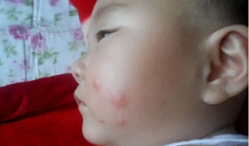 普及！宝宝湿疹不敢用药怕激素？湿疹护理指南来帮你
