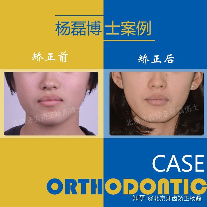 整牙半隐形牙套,缺牙可以用隐形牙套矫正的全过程