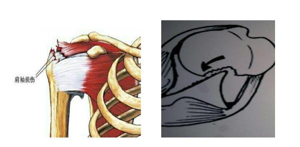 习惯性肩关节脱位怎么办,怎么检查肩关节是不是习惯性脱位