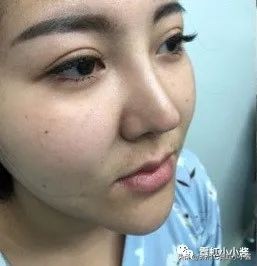 鼻子怎么修复好看呢,鼻型修复方法大全