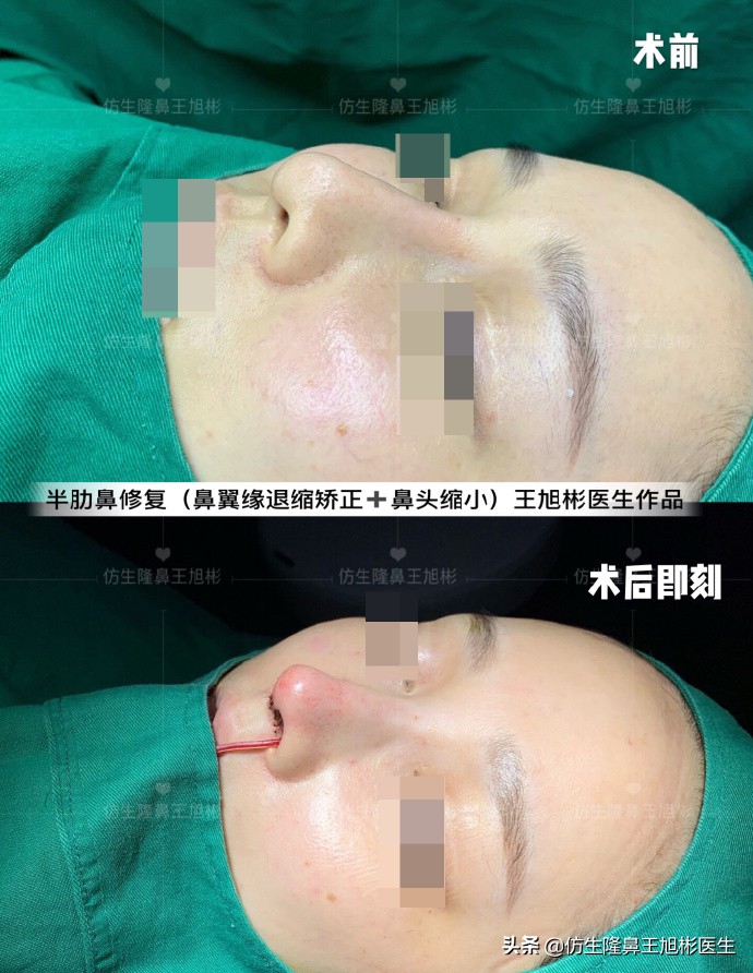 隆鼻的鼻翼怎么修复,隆鼻后多久可以做鼻翼缘矫正