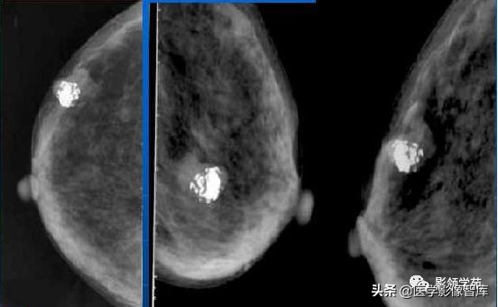 乳腺钙化怎么区分良性和恶性,乳腺钙化的诊断与分级