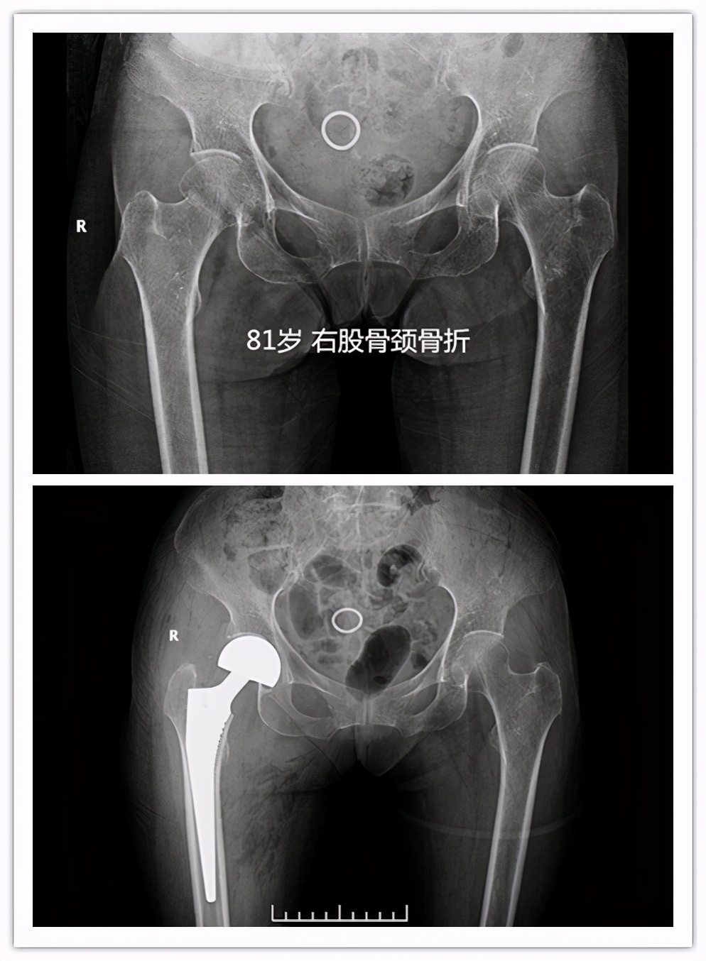 人生最后一次骨折怎么处理,老年髋部骨折是人生最后一次骨折