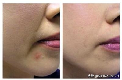 法令纹用什么方法去除效果好,去除法令纹的最有效的方法有哪些