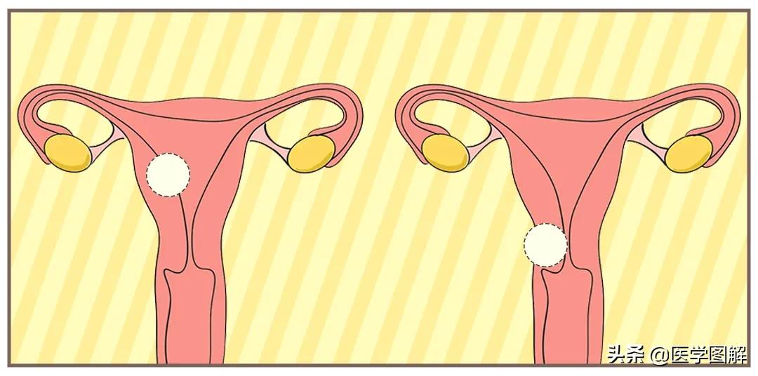 子宫肌瘤，比你想象的可怕！瞬间就危在旦夕？丨医学图解
