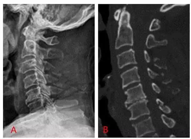 几种严重骨折医学名称,常见的骨折有哪些名称