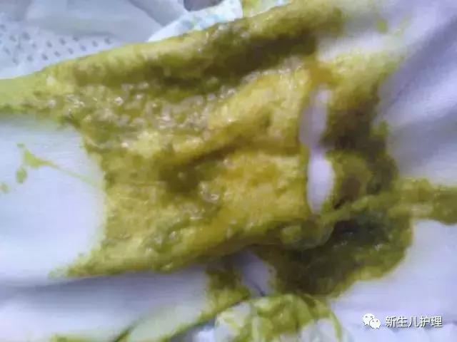 新手爸妈｜奶瓣、绿便、腹泻、便秘……宝宝各种便便真图全解必备