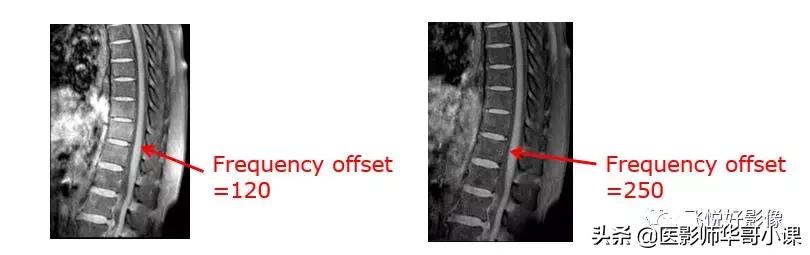 飞利浦磁共振独有技术,飞利浦磁共振减影技术