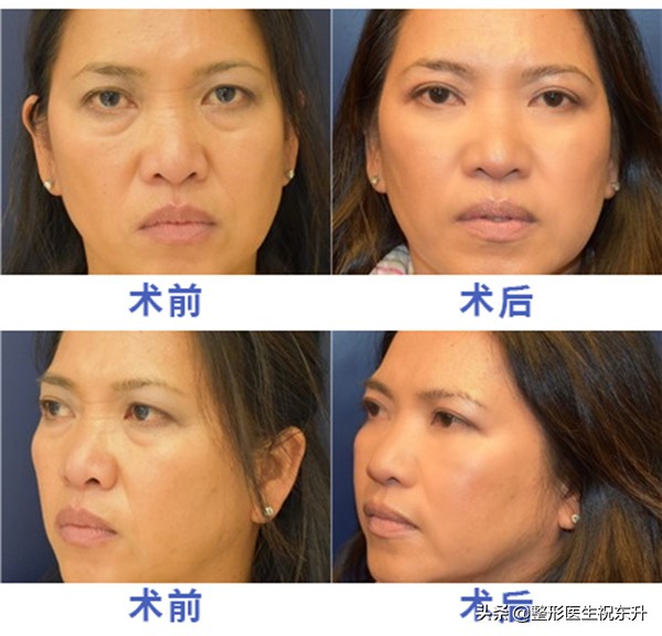 祛眼袋最全攻略,史上祛眼袋最强知识帖