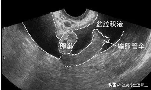 人体健康之盆腔炎(一)