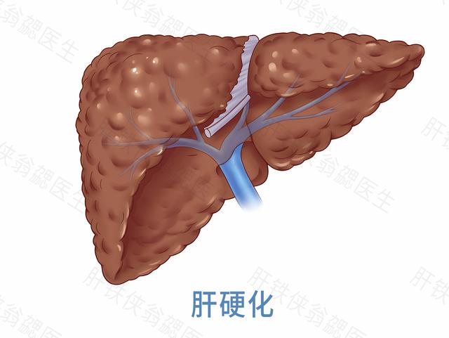 脾大会误诊吗,疑似脾大需要治疗吗