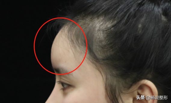 20岁面部凹陷如何改善,脂肪填充面部凹陷怎么导致的呢