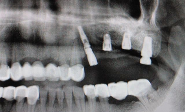 种植牙1万多嫌太贵，“3000元的种植牙”你敢种吗？