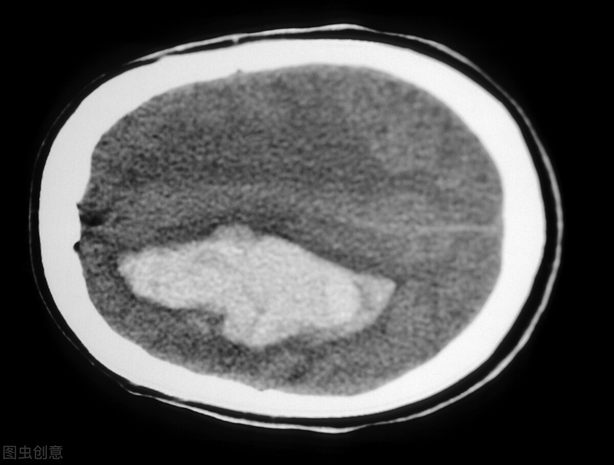 肺结节属不属于重疾,肺结节是不是属于肿瘤