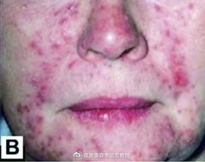 酒渣鼻有什么特效药,酒渣鼻的原因及治疗