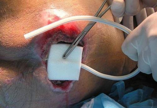 怎么护理好长期卧床病人褥疮,长期卧床的老人得了褥疮怎样护理