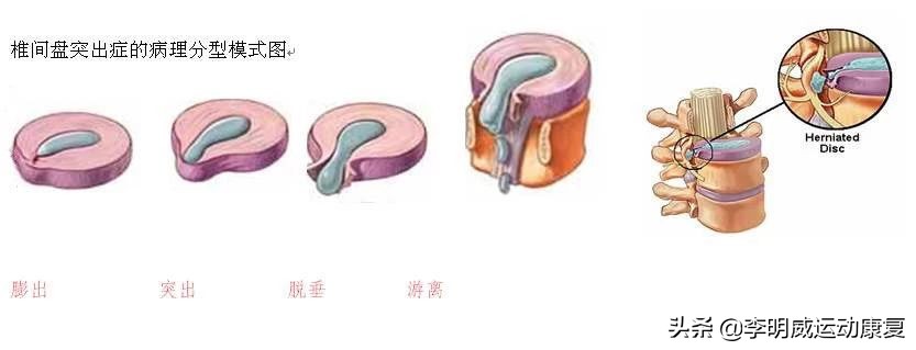 腰痛了最快恢复方法,你的腰还好吗是什么意思