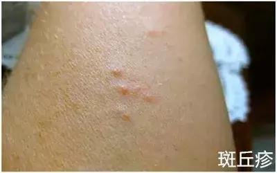 娃身上出了荨麻疹怎么办,娃儿有皮疹怎么止痒