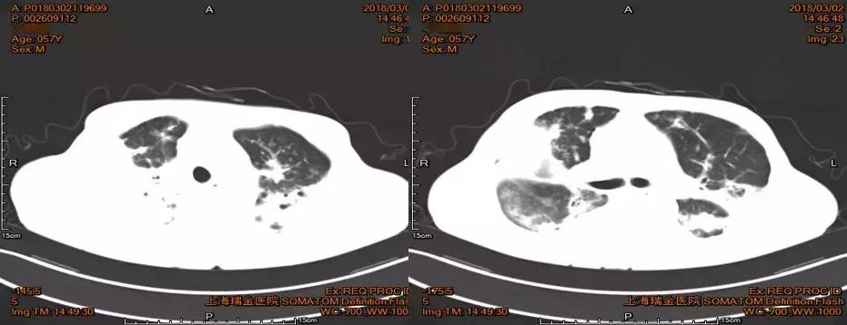 怎样确诊肺部真菌感染,侵袭性肺真菌病的确诊标准有哪些
