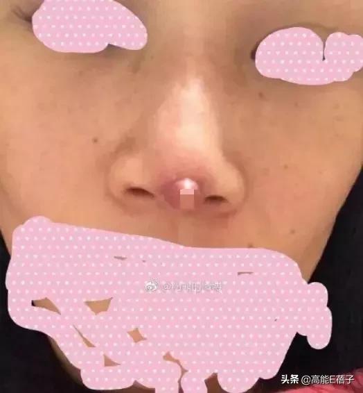 微整形需要多久,最受欢迎的5大微整形