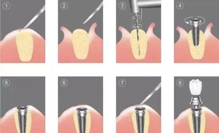 为什么都建议种植牙,种植是目前最好的缺失牙修复方式