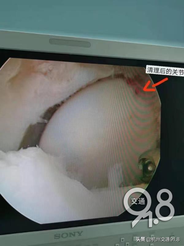 杭州老阿姨手肘关节突然疼得动不了了，医生手术取出了一团“海绵”……